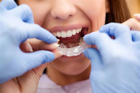 Dental Splints — Bexley Dentists - Family and Kids Dentist - Serene Dental