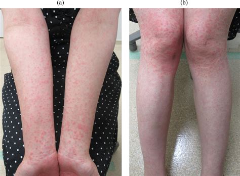 Skin rash following amoxicillin treatment - European Journal of ...
