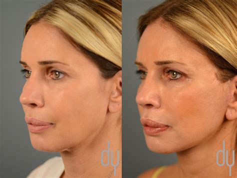 Facelift Before and After | Deep Plane Facelift Recovery - Beverly Hills Facial Plastic Surgery ...