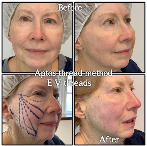 Thread lifts - minimally invasive cosmetic procedure