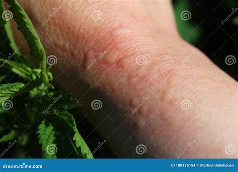 What Is A Nettle Rash at Gemma Dalton blog
