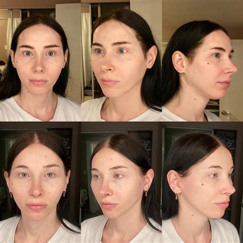 3 months post FFS : r/Transgender_Surgeries