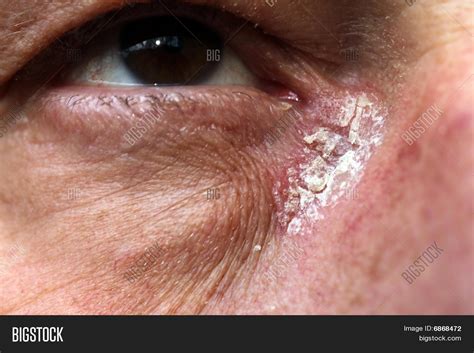 Psoriasis Around Eyes