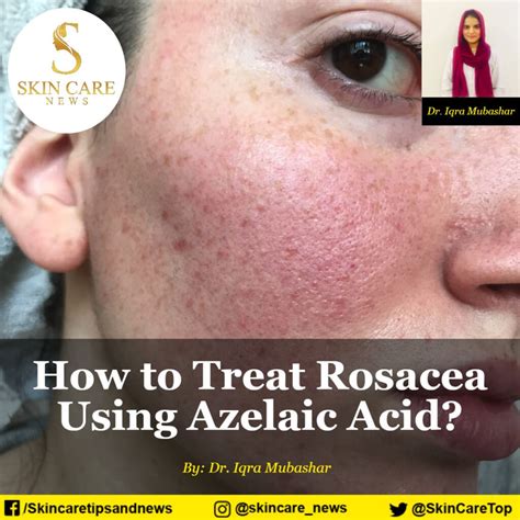 How to Treat Rosacea Using Azelaic Acid?--- Skincare News---