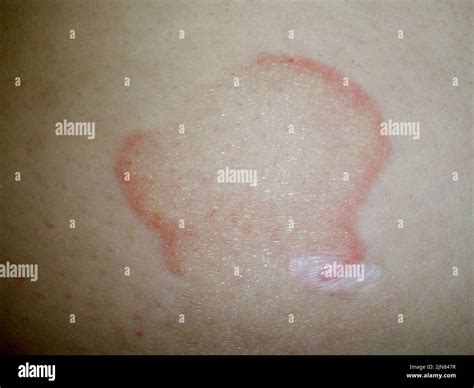 Erythema annulare centrifugum Stock Photo - Alamy