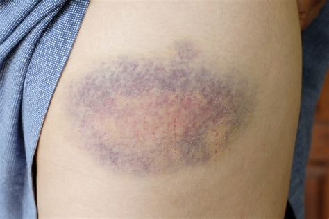 Muscle Contusion (Bruise) - OrthoInfo - AAOS