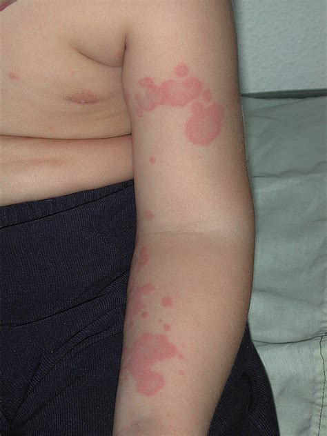 Síntomas De La Urticaria: Conoce Sus Características Y Tratamiento - ICWT