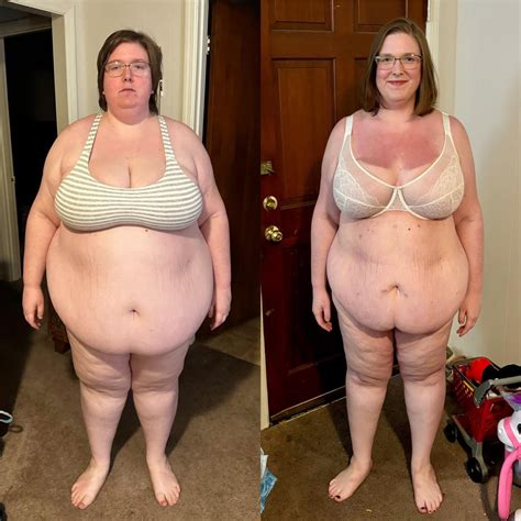 1 year post op! Down 170 pounds : r/BariatricSurgery