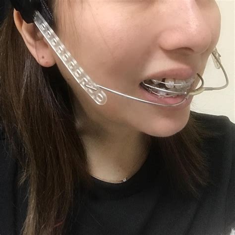 Headgear For Braces
