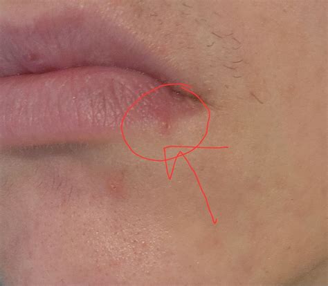 Pimple or cold sore? Pic included | BabyCenter