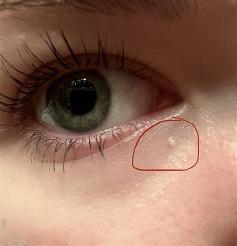 White Bump On Eyelid Causes Treatment Remedies Pictures Molluscum