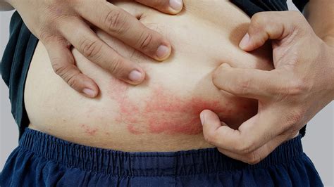 Rashes In The Stomach