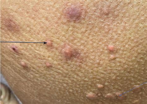 Xanthomas Causes And Treatment Options Skin Site Strange Asymptomatic