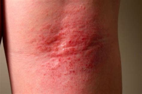 Eczema On Arm Crease Differential Diagnosis Of Very Itchy Skin