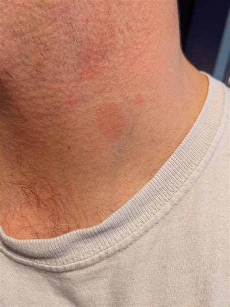 Red spots show up, last 4-6 months, then disappear. Neck and chest. No itching, not dry, can't ...
