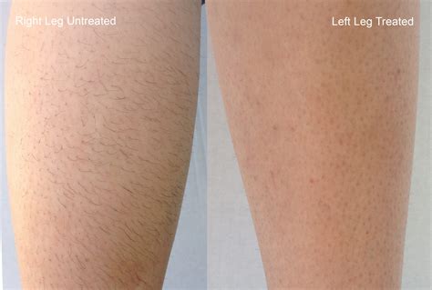 Pcos Hair Legs
