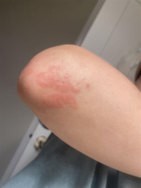 Why Is There A Bump On My Elbow at Joyce Collins blog