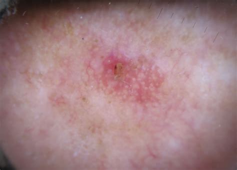 Actinic Keratosis Histology