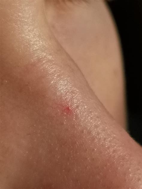 Red spot on nose not going away? : r/Dermatology