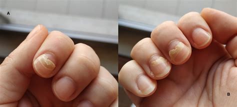 Onychomadesis Secondary To Hand Foot And Mouth Disease