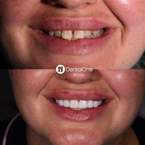 Porcelain Veneers | Veneer Teeth | Affordable Cosmetic Dentist | DentalOne