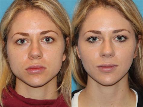 What is Masseter Botox - the daily glimmer