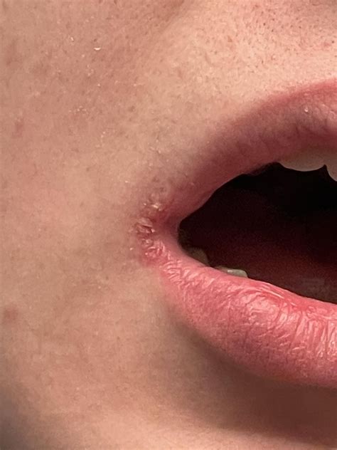 Cold Sores Corner Of Mouth Cold Sores Questions And Answers Herpes