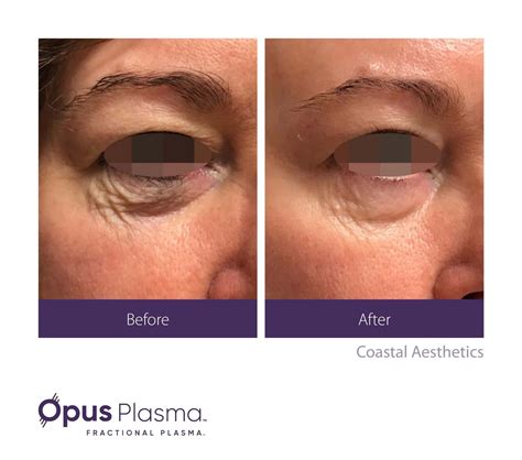 Schaumburg, IL | Alma Opus® | Horizon Medical Center