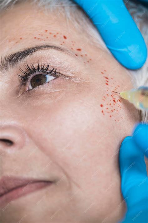 Premium Photo | Prp face injecting treatment cosmetic antiaging platelet rich plasma treatment