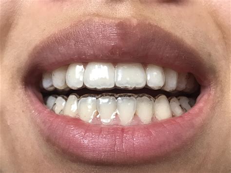 What Can I Put In My Retainer To Whiten My Teeth at Chloe Shipp blog