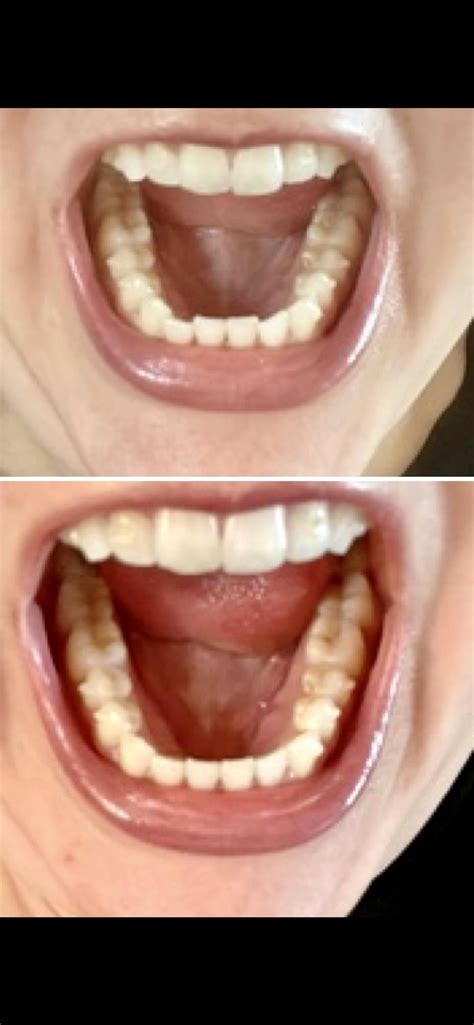 Invisalign 9 out of 14 Weeks : r/Invisalign