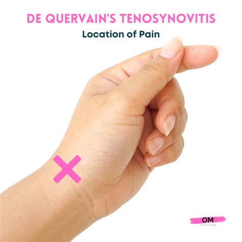 The Best De Quervain's Tenosynovitis Brace - The Osteo Mum