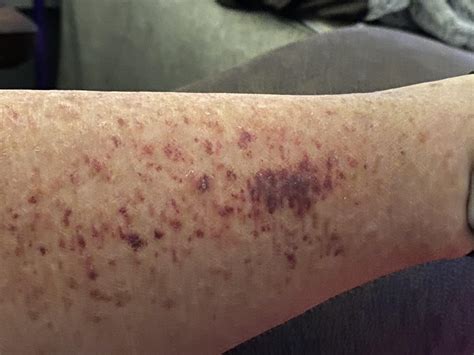 Bleeding Under Cast at Ronnie Baker blog