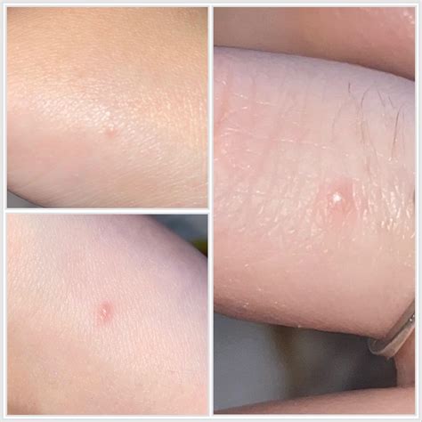 Small itchy bumps appearing on hands, what are they? : r/DermatologyQuestions