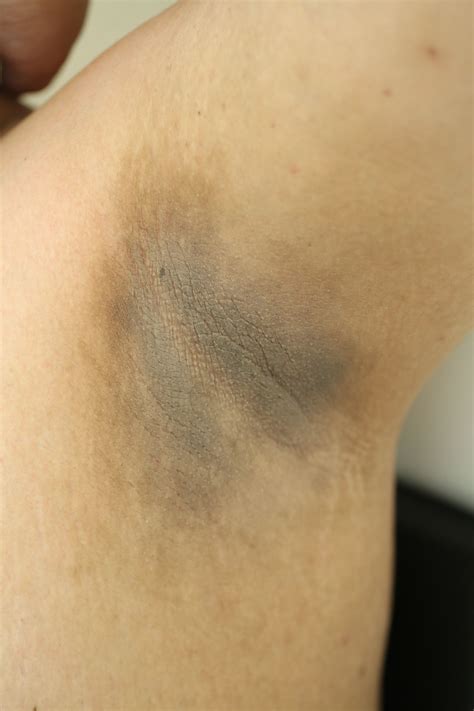 ACD A-Z of Skin - Acanthosis Nigricans