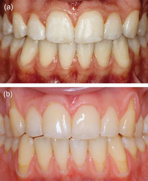 Early Gingivitis And Periodontal Disease