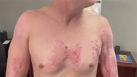 Lawsuit filed against Phoenix police after man burned