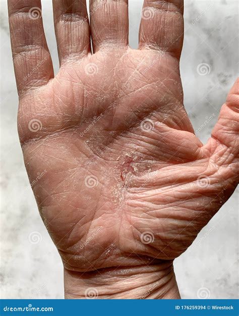 Vertical Shot of a Hand with a Dry Cracked Skin Stock Photo - Image of ...