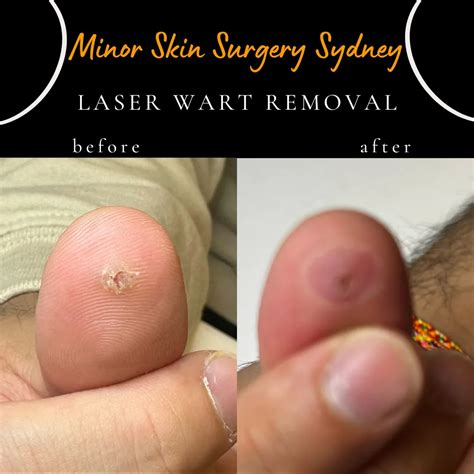Warts On Fingers Removal Wart Removal: Techniques And Prevention