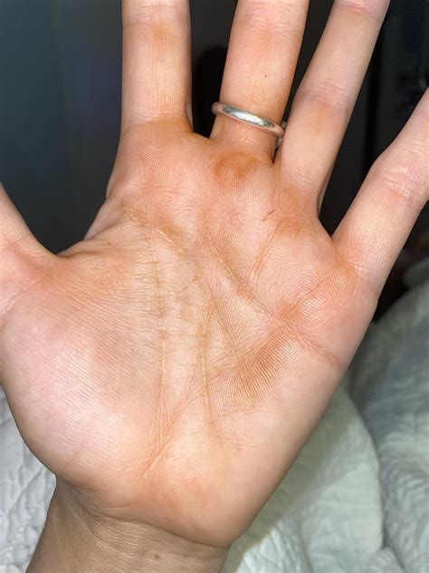 Orange/Rust Discoloration on Palm of Left Hand : r/medical