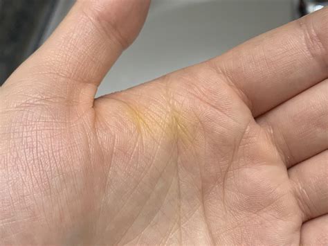 Yellow Spots On Palm Of One Hand at Gabriel Williamson blog