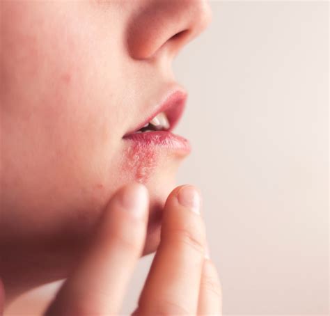 Tratamento para Herpes Genital Online | DoctorNow