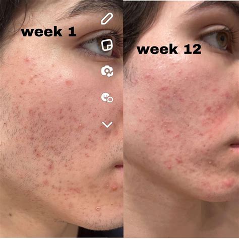 3 months on adapalene no improvement, need advice? : r/Skincare_Addiction