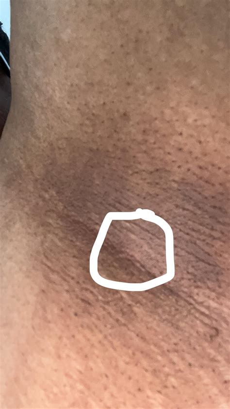 Small hard lump deep inside skin in armpit : r/DiagnoseMe
