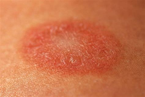 What Rash Looks Like Pityriasis Rosea Plants - Infoupdate.org