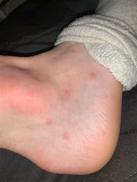 Itchy bumps on both my ankle, thought they were bug bites until it ...