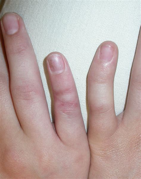 Pain Bending Little Finger at Kari Gonzales blog