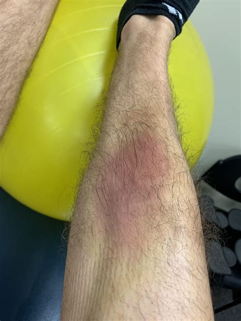 Shin Bruise from Post Surgical Brace? : r/ACL