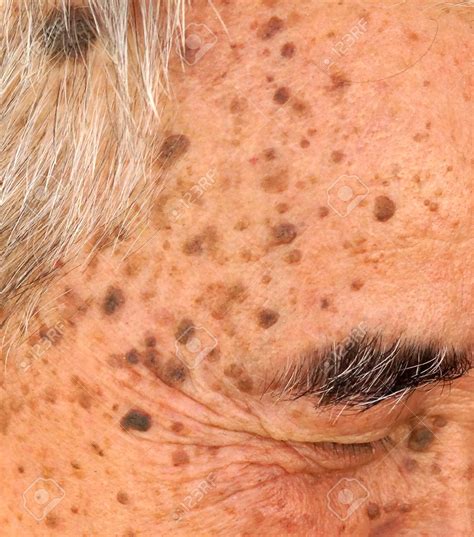 Home Remes For Seborrheic Keratosis - Homemade Ftempo