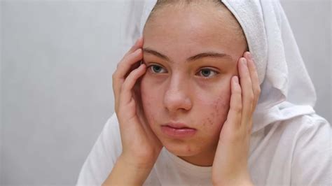 What Causes Blemishes on Face? – NutritionFact.in